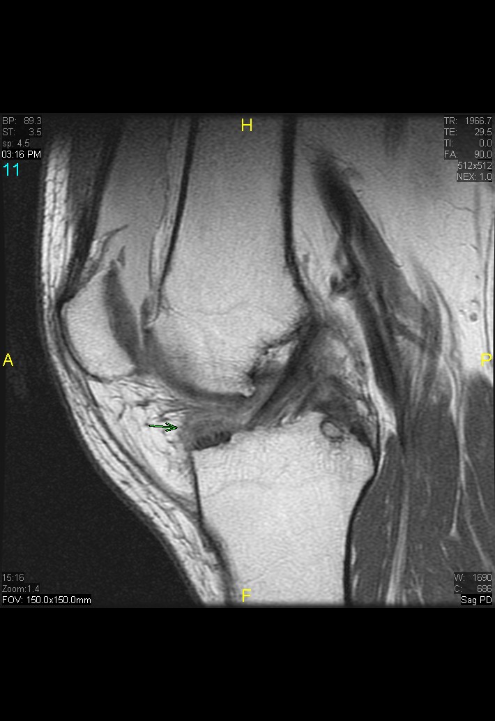 Figure 4 for case gout arthritis ( RID3567 )